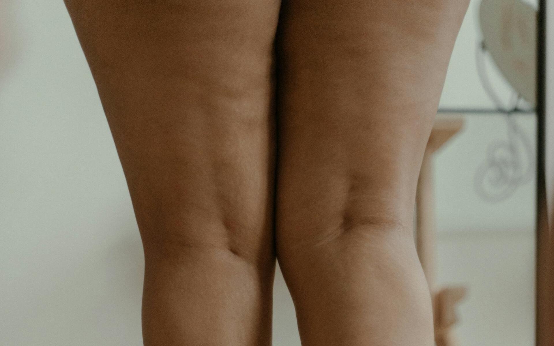 comment-reduire-la-cellulite-des-cuisses